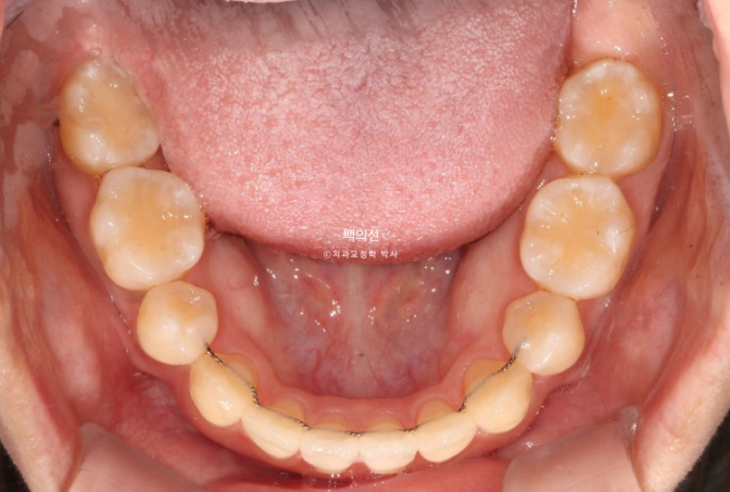 돌출입 교정 인비절라인 발치 교정 개방교합 치료 후기 관련 이미지 21