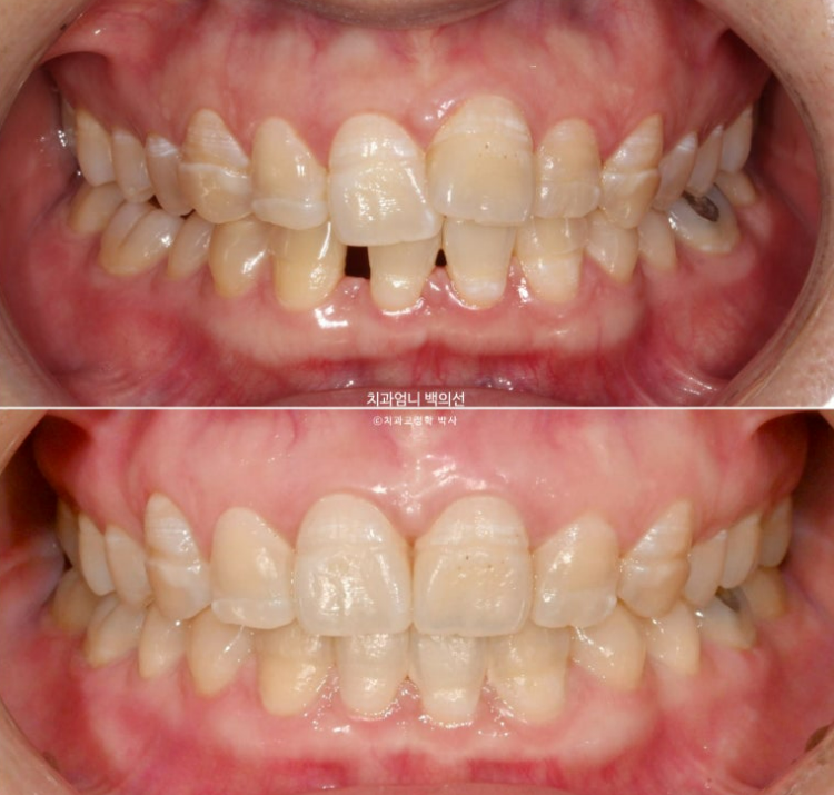 30대 교정 돌출입 교정 덧니 발치교정 치료기간 1년 8개월 관련 이미지 12