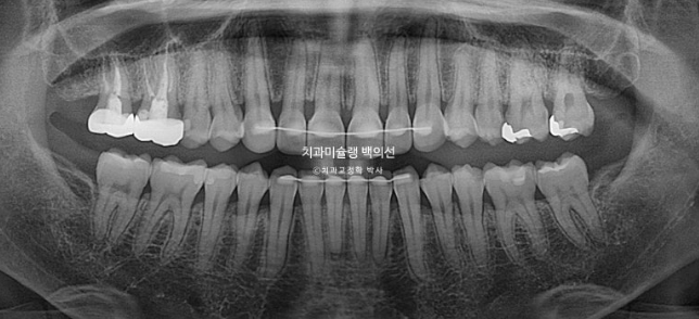 비발치 덧니 교정 인비절라인 과개교합 교정 무삭제 라미네이트 치료 후기 관련 이미지 26