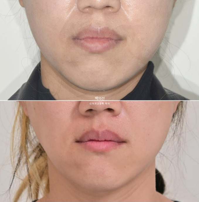 거미스마일 교정 돌출입 발치교정 입술부전 호두턱 치료기간 2년반 관련 이미지 21