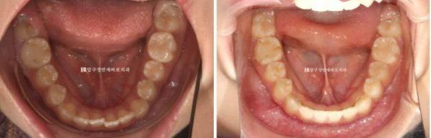 어린이 투명교정 인비절라인 틴 덧니 교정 후기 관련 이미지 14