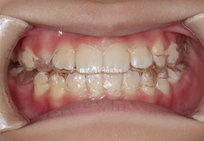 Simultaneous Arch Expansion and Teeth Alignment for Elementary School Children with Invisalign｜Invisalign First image 5