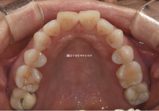 강남 중장년 교정|40~50대 잇몸이 약해도 교정할 수 있을까요? 잇몸퇴축 관련 이미지 5