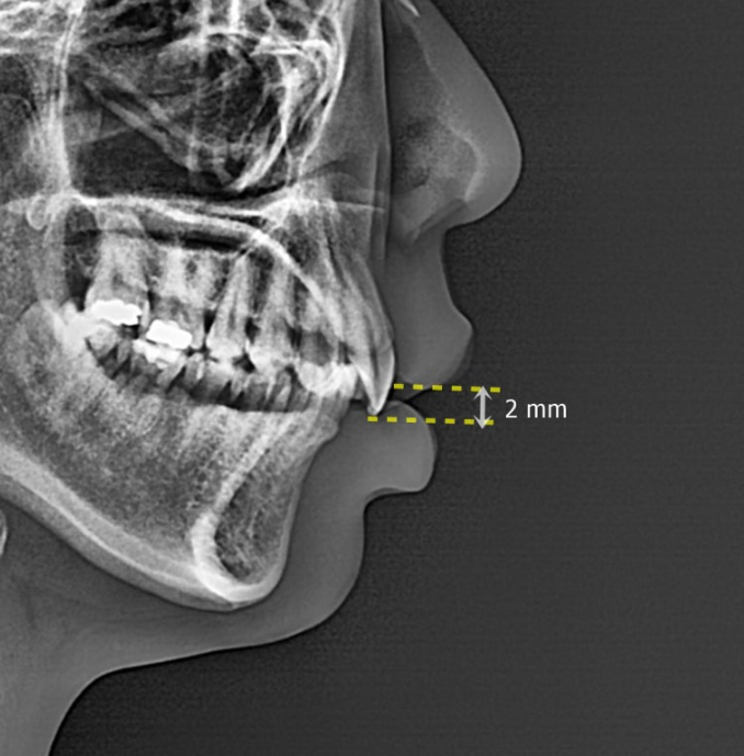 잇몸미소 거미스마일 원인에 따라 다른 치료방법? 관련 이미지 2
