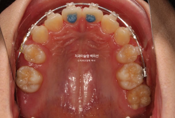 덧니 돌출입 발치교정 상악만 2개 편악 발치 클리피씨 입술부전증 치료 관련 이미지 8