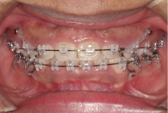 거미스마일 잇몸미소 발치 돌출입 과개교합 교정 후기 관련 이미지 6