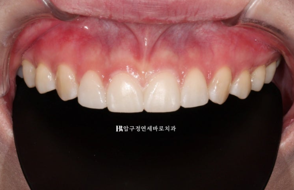 Four No-Prep Veneers for Dwarf Teeth and Conical Front Teeth image 6