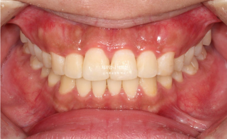 앞니 부분교정 덧니 교정 블랙트라이앵글 부정교합 마모 시뮬레이션 치료기간 5개월 관련 이미지 11