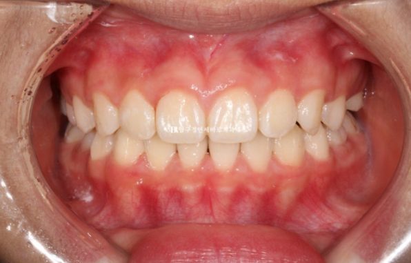 압구정 어린이교정 인비절라인 퍼스트 악궁확장 덧니 교정 관련 이미지 7