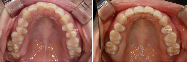 돌출입 덧니 발치 교정 인비절라인 교정 후기 관련 이미지 22