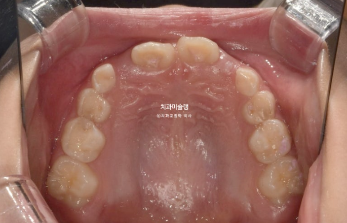 어린이 투명교정 인비절라인 퍼스트 과개교합 교정 후기 관련 이미지 4