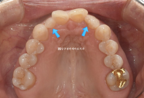 50s Invisalign Lite No-Prep Laminate Bunny Teeth image 4