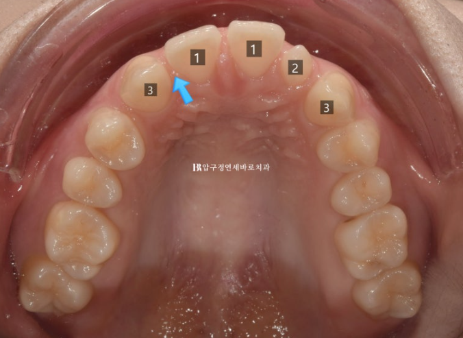 Actual Case of Treating Congenitally Missing and Peg-Shaped Teeth Without Implants image 4