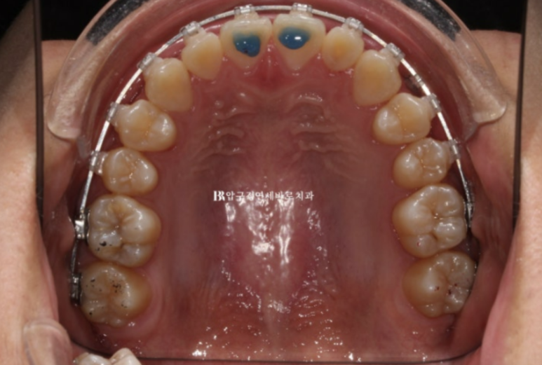 옥니교정 / 웃을때 아랫니만 보여요. 앞니 노출도 교정? 관련 이미지 6