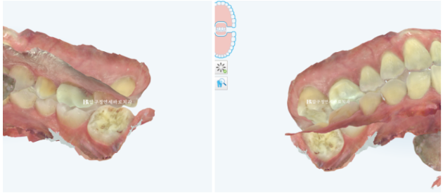 40대 발치교정 대신 인비절라인 라이트? 10개월 치료로 어디까지 가능할까요? 관련 이미지 7
