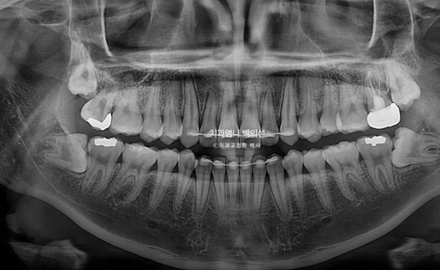 앞니 부분 교정 급속 교정 토끼이빨 MTA 미니튜브 치간삭제 치료기간 9개월 관련 이미지 20