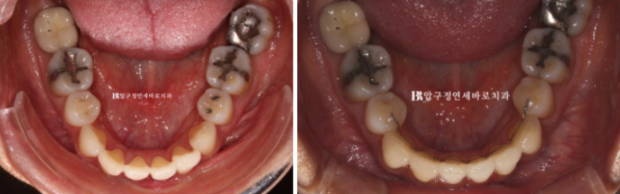 How Can Black Triangles Be Removed? Is Re-treatment Orthodontics an Option? image 10