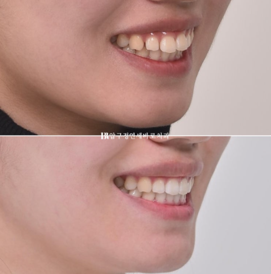 돌출입 교정 치아 벌어짐 인비절라인 투명교정 치료 관련 이미지 12