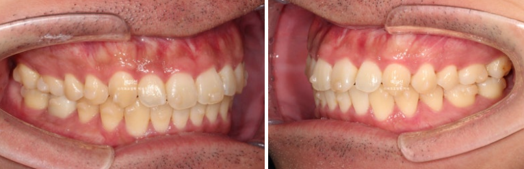 가위교합 나비치아 미니스크류 덧니 교정 인비절라인 라이트 관련 이미지 14