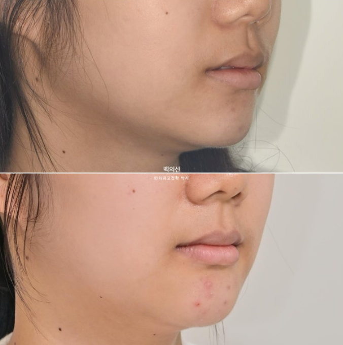 덧니 발치교정 클리피씨 입매 부작용 인중 입술 잇몸 퇴축 관련 이미지 19