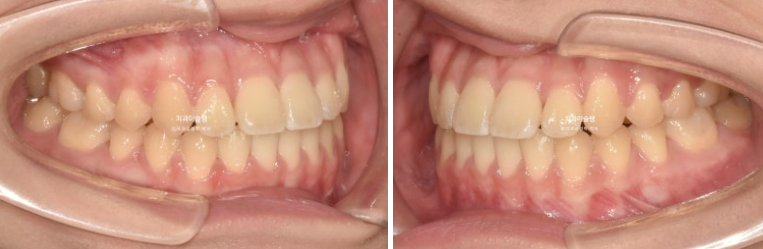 비발치 비수술 주걱턱 반대교합 재교정 치료 관련 이미지 10