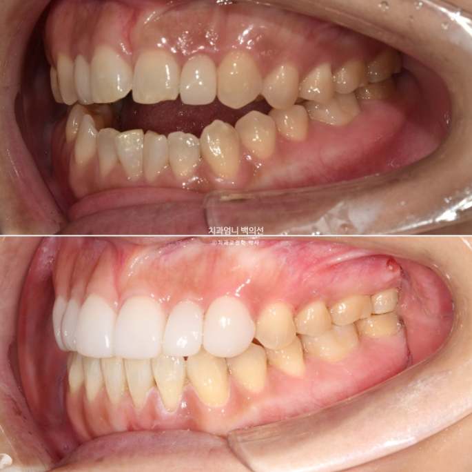 비수술 개방교합 클리피씨 30대 무삭제 라미네이트 치료기간 2년 관련 이미지 18