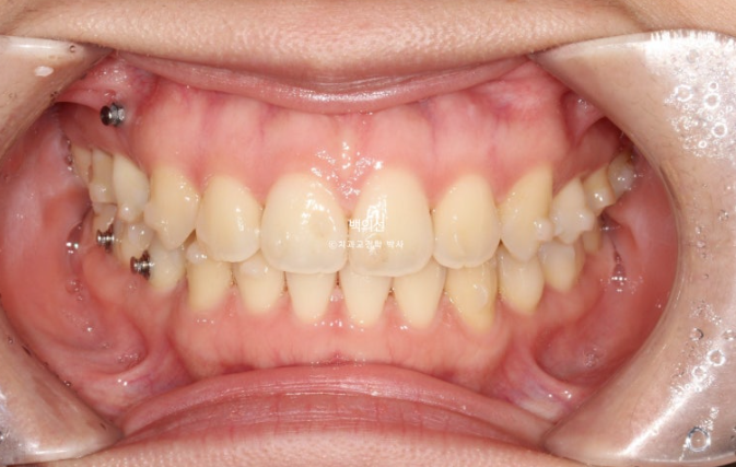 돌출입 교정 인비절라인 발치 교정 개방교합 치료 후기 관련 이미지 16