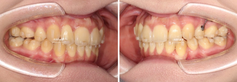 30대 인비절라인 덧니 발치교정 개방교합 치료 관련 이미지 16