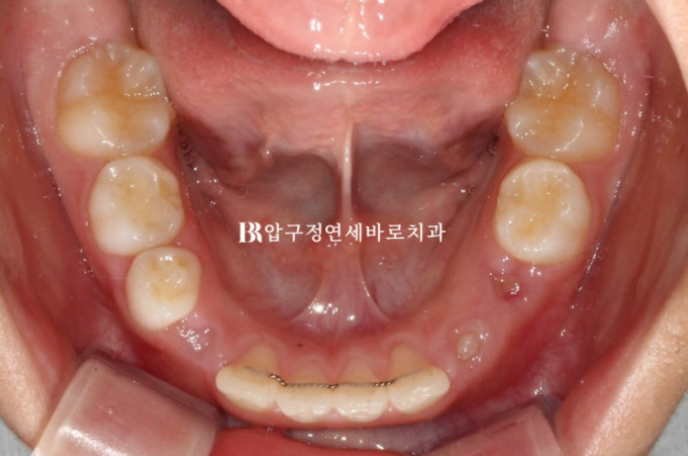 무턱교정 어린이 투명교정 인비절라인 퍼스트 교정 후기 관련 이미지 19