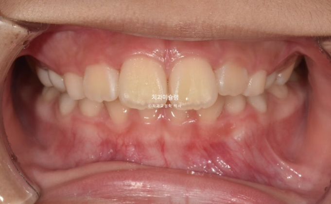 어린이 돌출입 교정 무턱 투명교정 인비절라인 퍼스트 관련 이미지 2