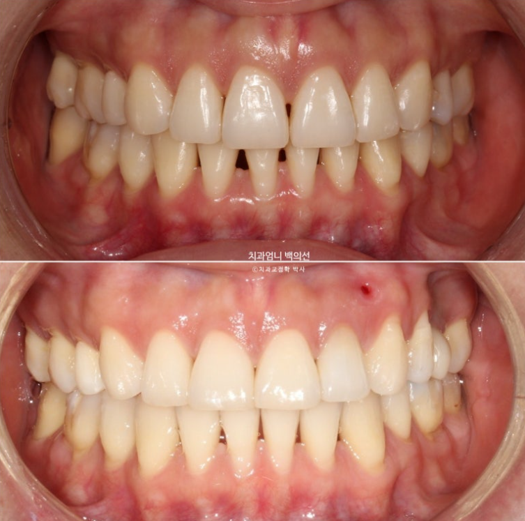 옥니 교정 역교정 재교정 무턱교정 치료기간 1년 10개월 관련 이미지 18