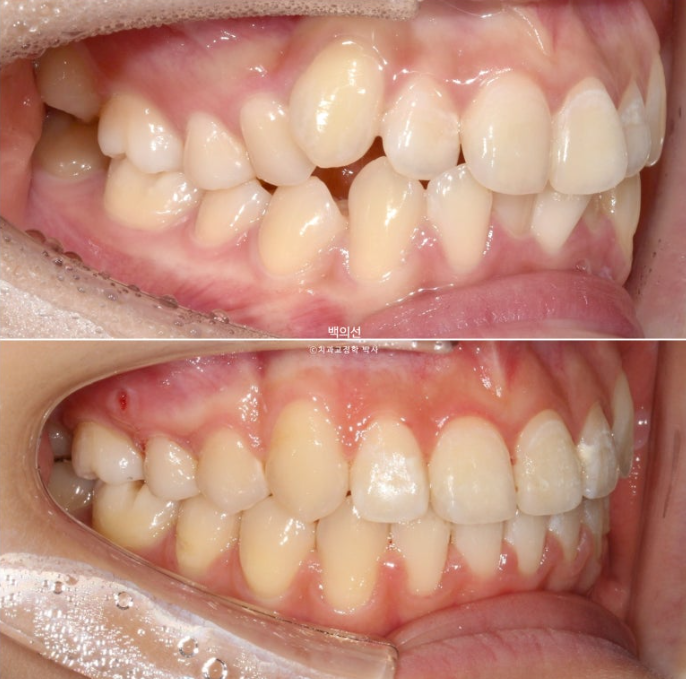 비발치 덧니교정 인비절라인 교정 사랑니 이용 교정 관련 이미지 18