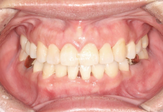 거미스마일 교정 돌출입 발치교정 입술부전 호두턱 치료기간 2년반 관련 이미지 16