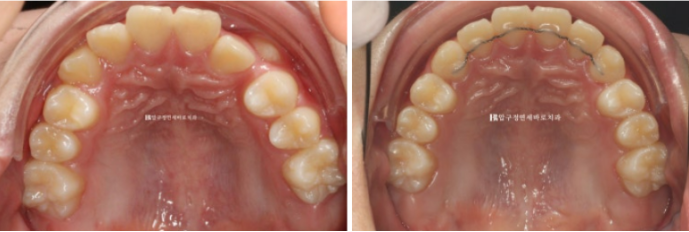 덧니 인비절라인 교정 :: 강남 인비절라인 교정치과 관련 이미지 6