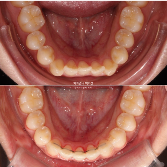Inward-Tilted Teeth Orthodontic Treatment Review | A Real Case of Treating Congenitally Missing Lower Incisor (Three Lower Front Teeth) Without Extractions image 13