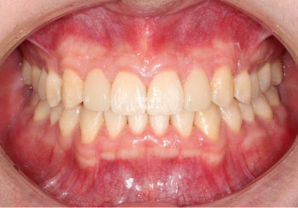 비대칭 비발치 거미스마일 잇몸미소 중심선 가위교합치료 무삭제 라미네이트 관련 이미지 20