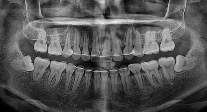 잇몸미소 거미스마일 치료 옥니 교정 잇몸성형 후기 관련 이미지 22