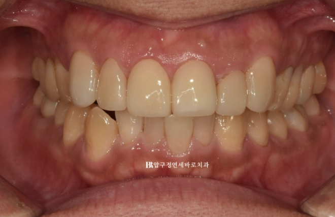 40대 치아교정 인비절라인 라이트 덧니 교정 어금니 교합 부작용 관련 이미지 2