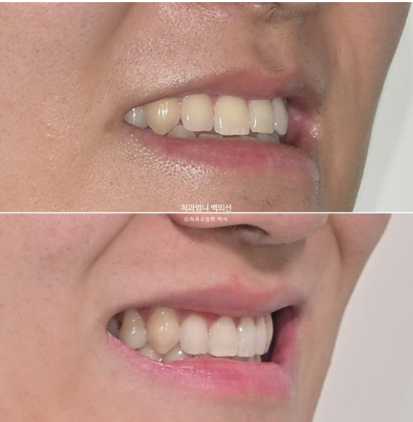MSE Palatal Expansion Invisalign Underbite Correction, Non-Surgical image 25