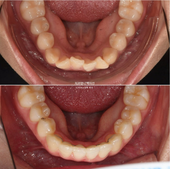 앞니 부분 교정 토끼이빨 덧니교정 ? 관련 이미지 16