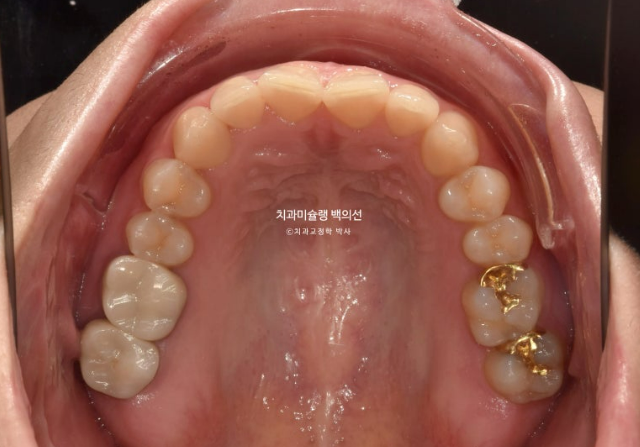 비발치 덧니 교정 인비절라인 과개교합 교정 무삭제 라미네이트 치료 후기 관련 이미지 4
