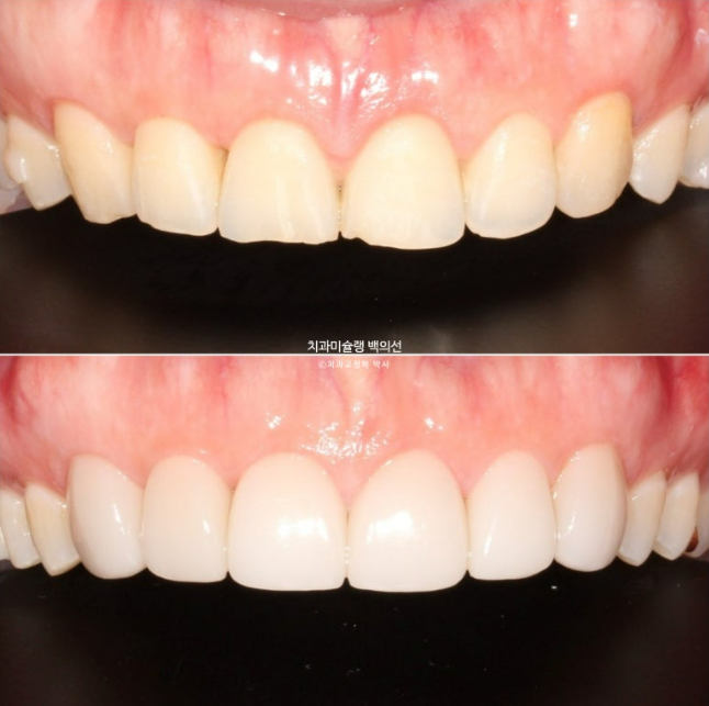 비발치 덧니 교정 인비절라인 과개교합 교정 무삭제 라미네이트 치료 후기 관련 이미지 14