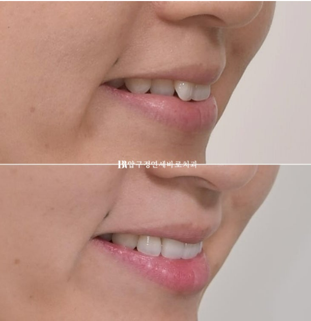 30대 토끼이빨 교정 반대교합 앞니 부분교정 후기 관련 이미지 12