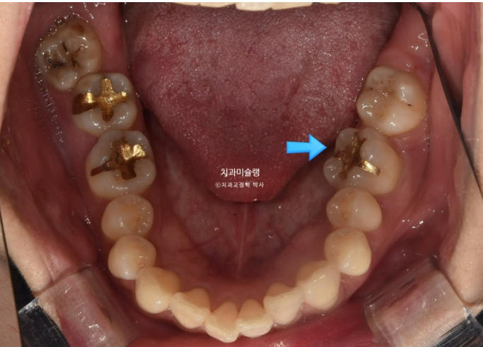 비발치 돌출입 인비절라인 교정 가위교합 중심선 맞추기 관련 이미지 6