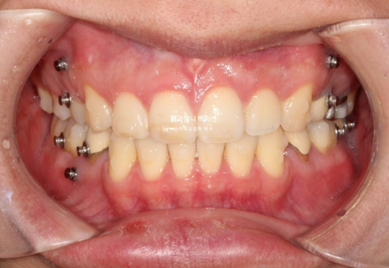 돌출입 발치 교정 인비절라인 후기 미니스크류 관련 이미지 12