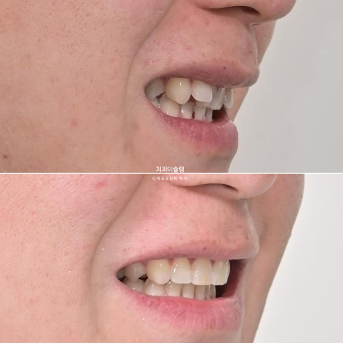 덧니 앞니 부분교정 급속교정 단기 MTA 미니튜브 기간 6개월 관련 이미지 1