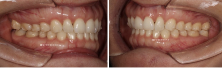 인비절라인 라이트 가위교합 치아 벌어짐 치료 관련 이미지 5