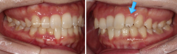 앞니부분교정 기간? MTA 미니튜브 교정 반대교합 교정 관련 이미지 2