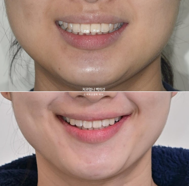 돌출입 교정 인비절라인 발치 교정 후기 관련 이미지 1