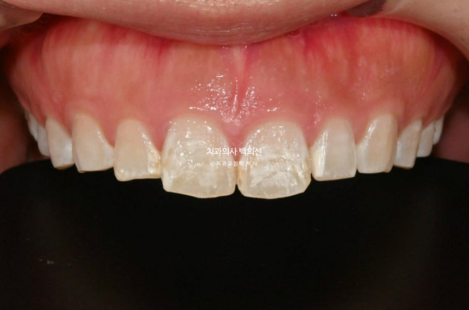 반점치 반상치 치아 하얀 얼룩 치료하기 관련 이미지 3